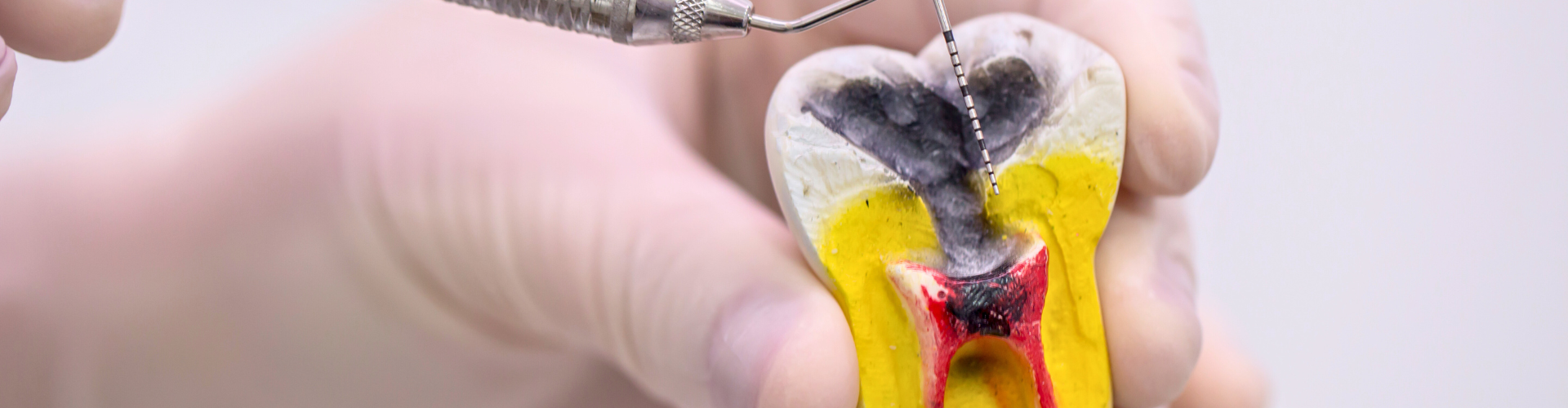 Hand holding tooth model showing the inside.